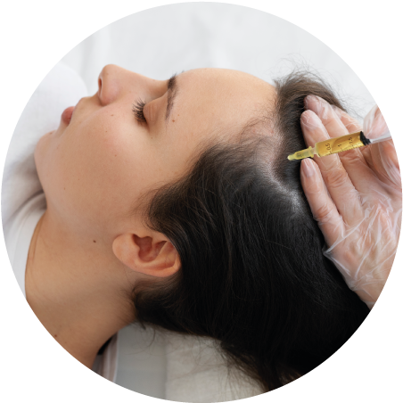 Mesoterapia Capilar