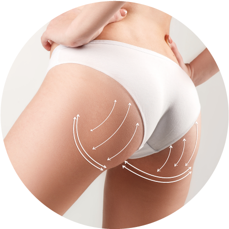 Tratamento para Flacidez, Estrias e Celulite